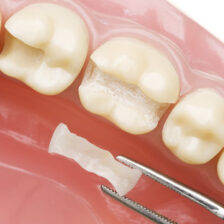 成田(千葉県成田市)の歯医者、メイプル歯科はなのき台クリニックで詰め物や被せ物が取れた場合の対処法についての解説