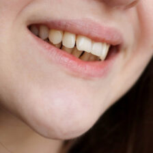 成田(千葉県成田市)の歯医者、メイプル歯科はなのき台クリニックで矯正後の後戻りについての解説