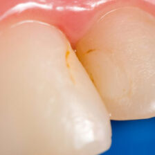 成田(千葉県成田市)の歯医者、メイプル歯科はなのき台クリニックで詰め物と歯の境目が茶色く変色するのはなぜ?二次カリエスの予防法を解説